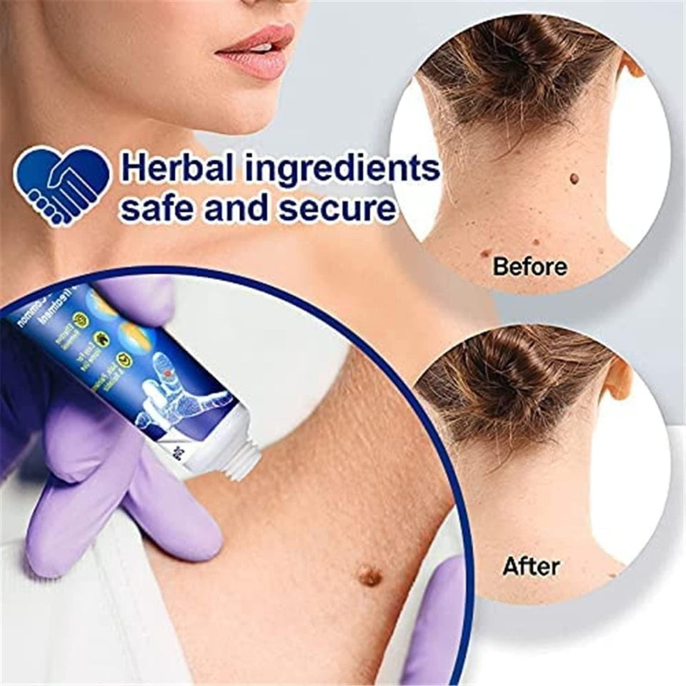 ATEMPORAL WARTS REMOVER CREAM ⭐️⭐️⭐️⭐️⭐️ (14758+ reviews)